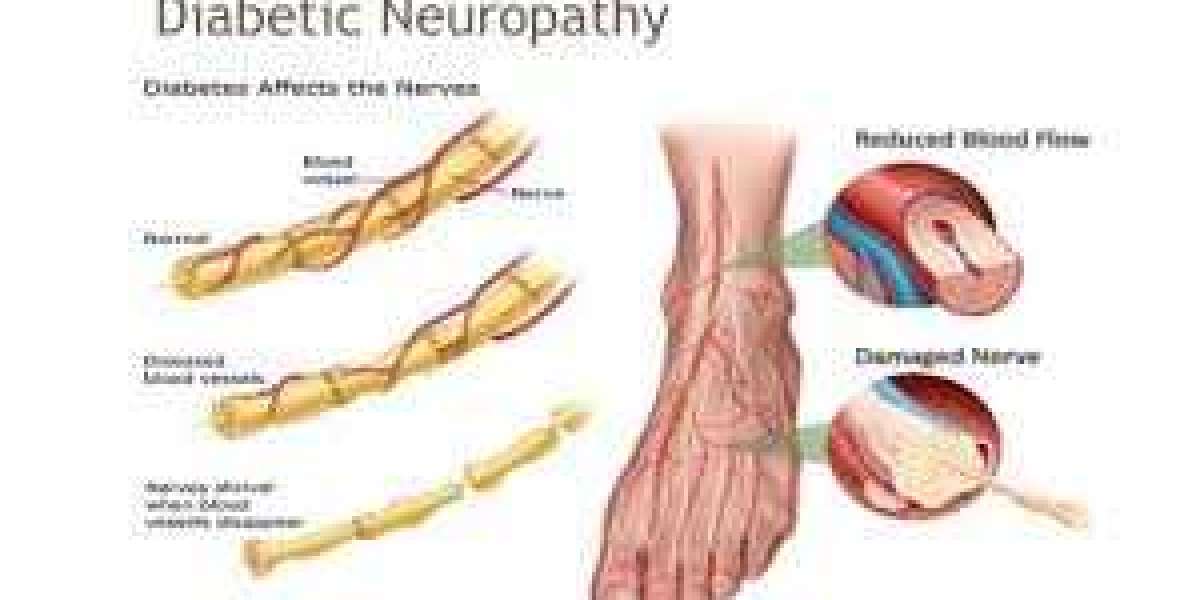 Can Gabapentin 300mg Effectively Manage Diabetic Neuropathy?